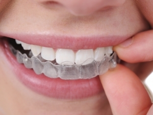 Scopri gli aligner trasparenti di INVISALIGN