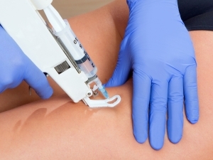 Mesoterapia